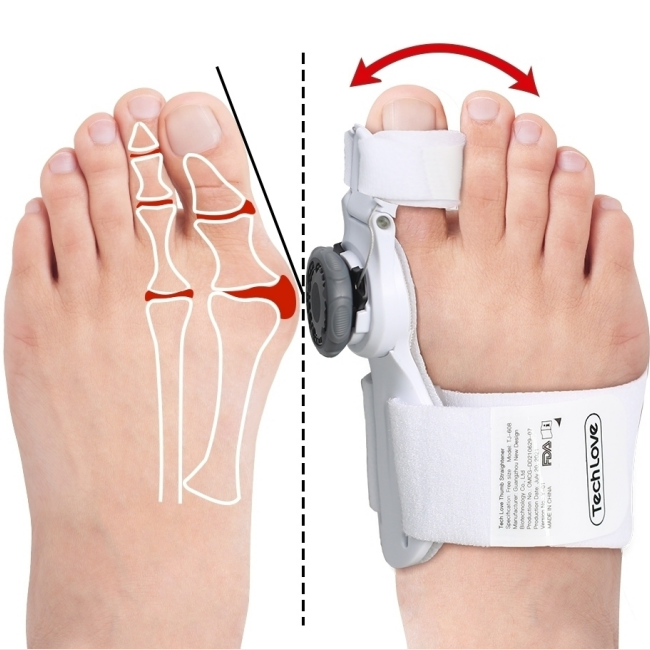 Correcteur Hallux valgus, Correcteur d'oignon